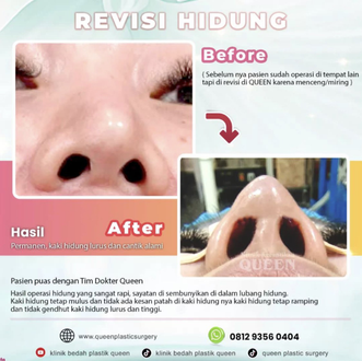 Hasil Rhinoplasty Queen Plastic Surgery, foto 99