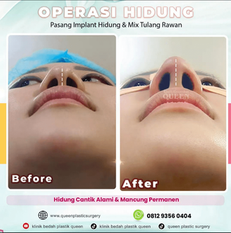 Hasil Rhinoplasty Queen Plastic Surgery, foto 87