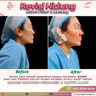 Hasil Rhinoplasty Queen Plastic Surgery, foto 24