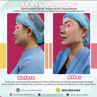 Hasil Rhinoplasty Queen Plastic Surgery, foto 88