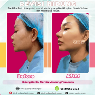 Hasil Rhinoplasty Queen Plastic Surgery, foto 89