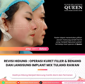 Hasil Rhinoplasty Queen Plastic Surgery, foto 90