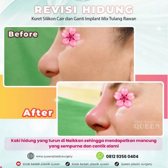 Hasil Rhinoplasty Queen Plastic Surgery, foto 91
