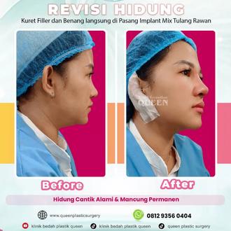 Hasil Rhinoplasty Queen Plastic Surgery, foto 92