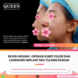 Hasil Rhinoplasty Queen Plastic Surgery, foto 93