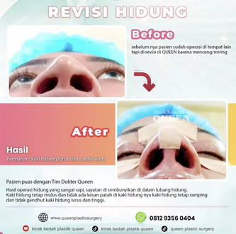 Hasil Rhinoplasty Queen Plastic Surgery, foto 95