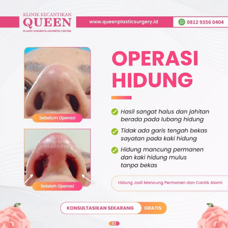 Hasil Rhinoplasty Queen Plastic Surgery, foto 94