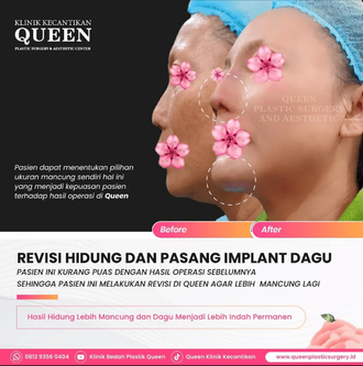 Hasil Rhinoplasty Queen Plastic Surgery, foto 96