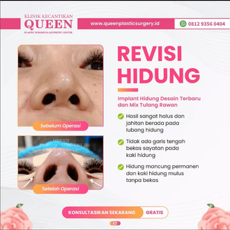 Hasil Rhinoplasty Queen Plastic Surgery, foto 23