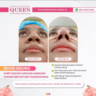 Hasil Rhinoplasty Queen Plastic Surgery, foto 98