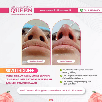 Hasil Rhinoplasty Queen Plastic Surgery, foto 85