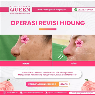 Hasil Rhinoplasty Queen Plastic Surgery, foto 84