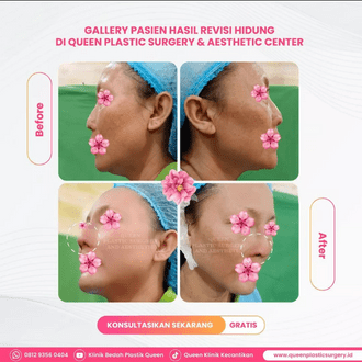 Hasil Rhinoplasty Queen Plastic Surgery, foto 83