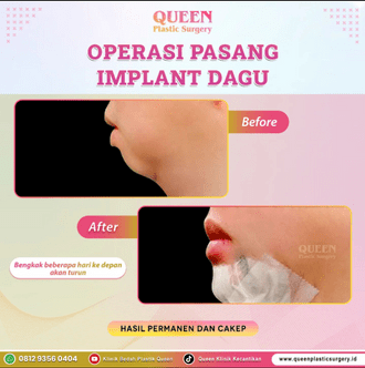 Hasil Rhinoplasty Queen Plastic Surgery, foto 81