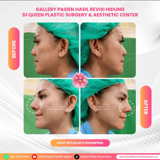Hasil Rhinoplasty Queen Plastic Surgery, foto 79