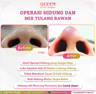 Hasil Rhinoplasty Queen Plastic Surgery, foto 78