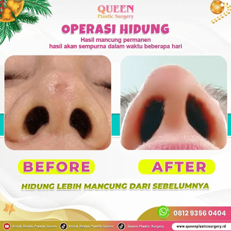 Hasil Rhinoplasty Queen Plastic Surgery, foto 75