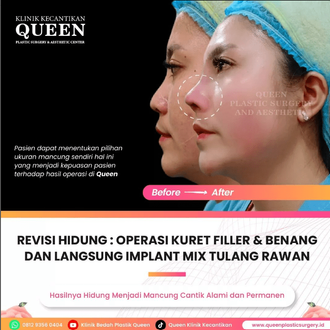 Hasil Rhinoplasty Queen Plastic Surgery, foto 12