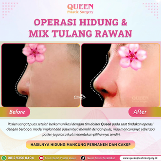 Hasil Rhinoplasty Queen Plastic Surgery, foto 70