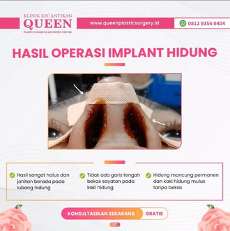 Hasil Rhinoplasty Queen Plastic Surgery, foto 13