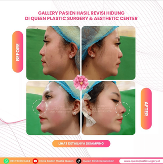 Hasil Rhinoplasty Queen Plastic Surgery, foto 14