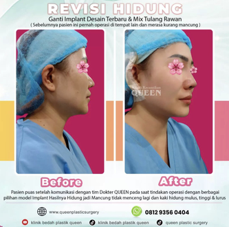 Hasil Rhinoplasty Queen Plastic Surgery, foto 15