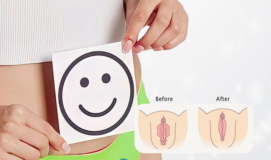 LABIAPLASTY SETELAH PENURUNAN BERAT BADAN