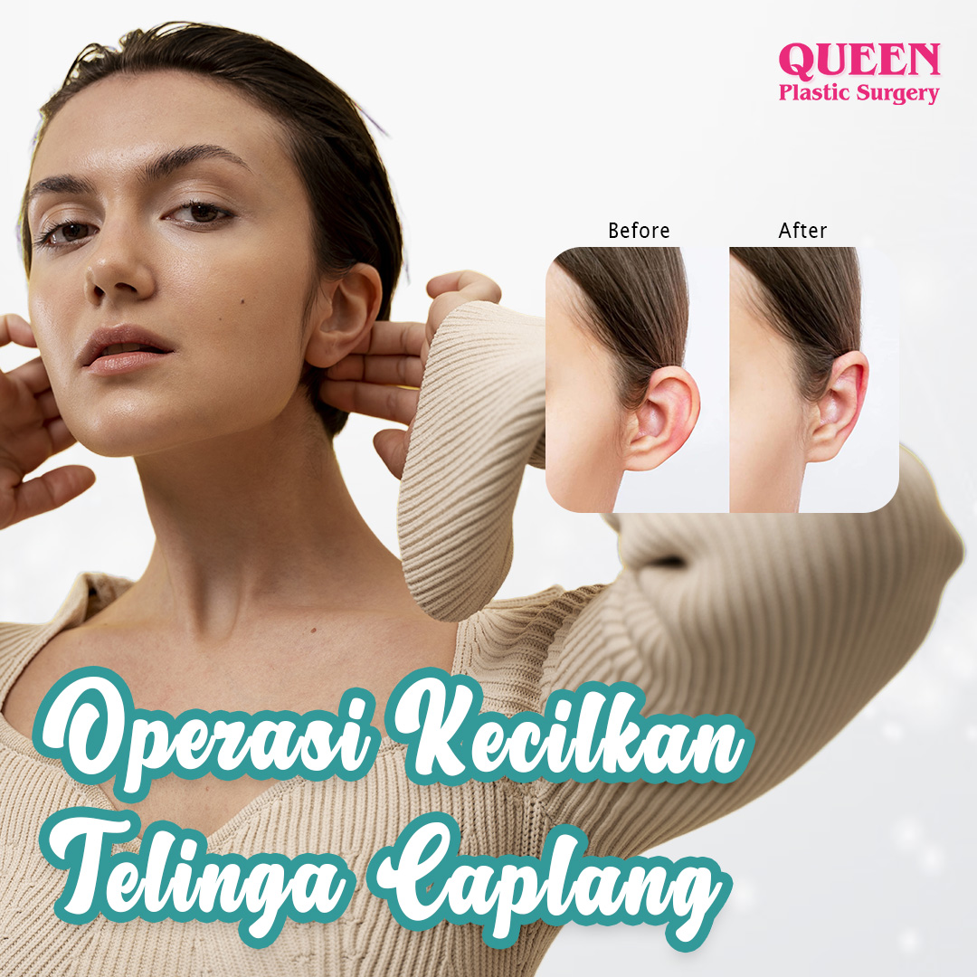https://queenplasticsurgery.id/wp-content/uploads/2024/02/Cover-Operasi-Kecilkan-Telinga-Caplang-web.jpg