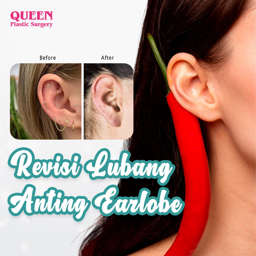https://queenplasticsurgery.id/wp-content/uploads/2024/02/Cover-Revisi-Lubang-Anting-Earlobe-web.jpg