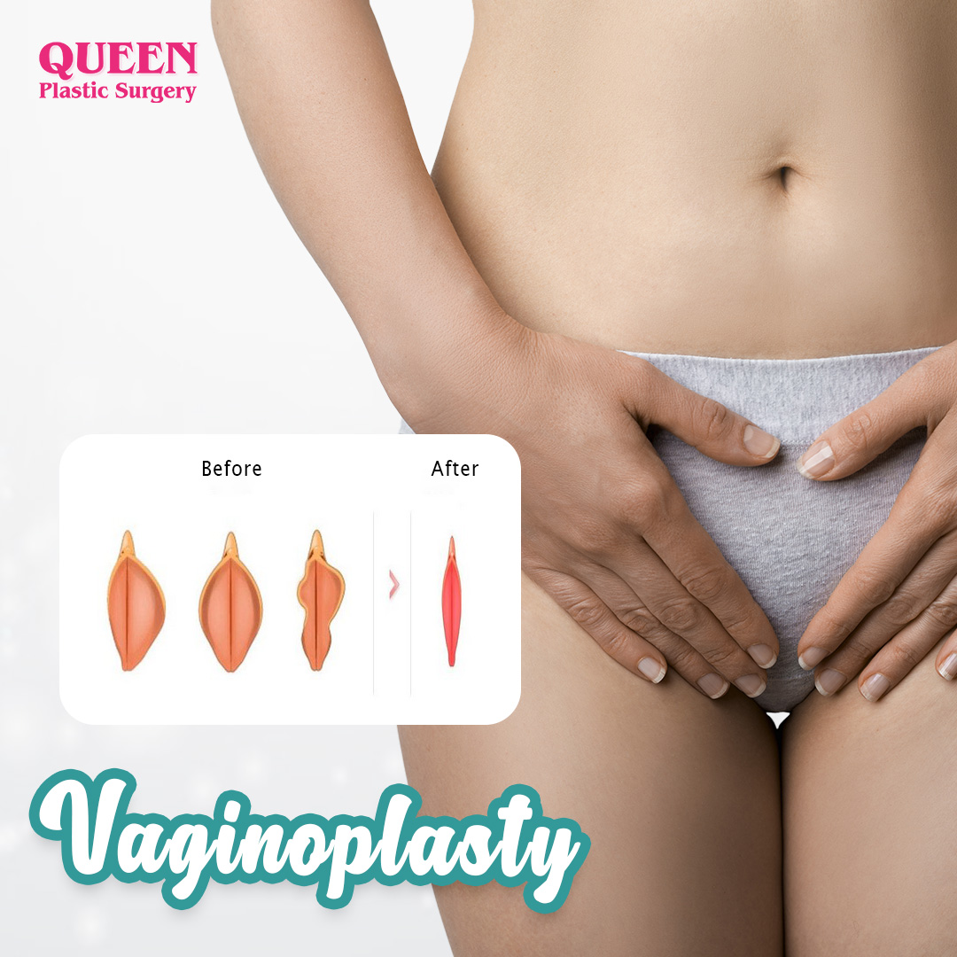 Cover-Vaginoplasty-web https://queenplasticsurgery.id/wp-content/uploads/2024/02/Cover-Vaginoplasty-web.jpg
