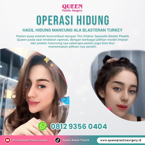Operasi Hidung Mancung Permanen dan Berkualitas