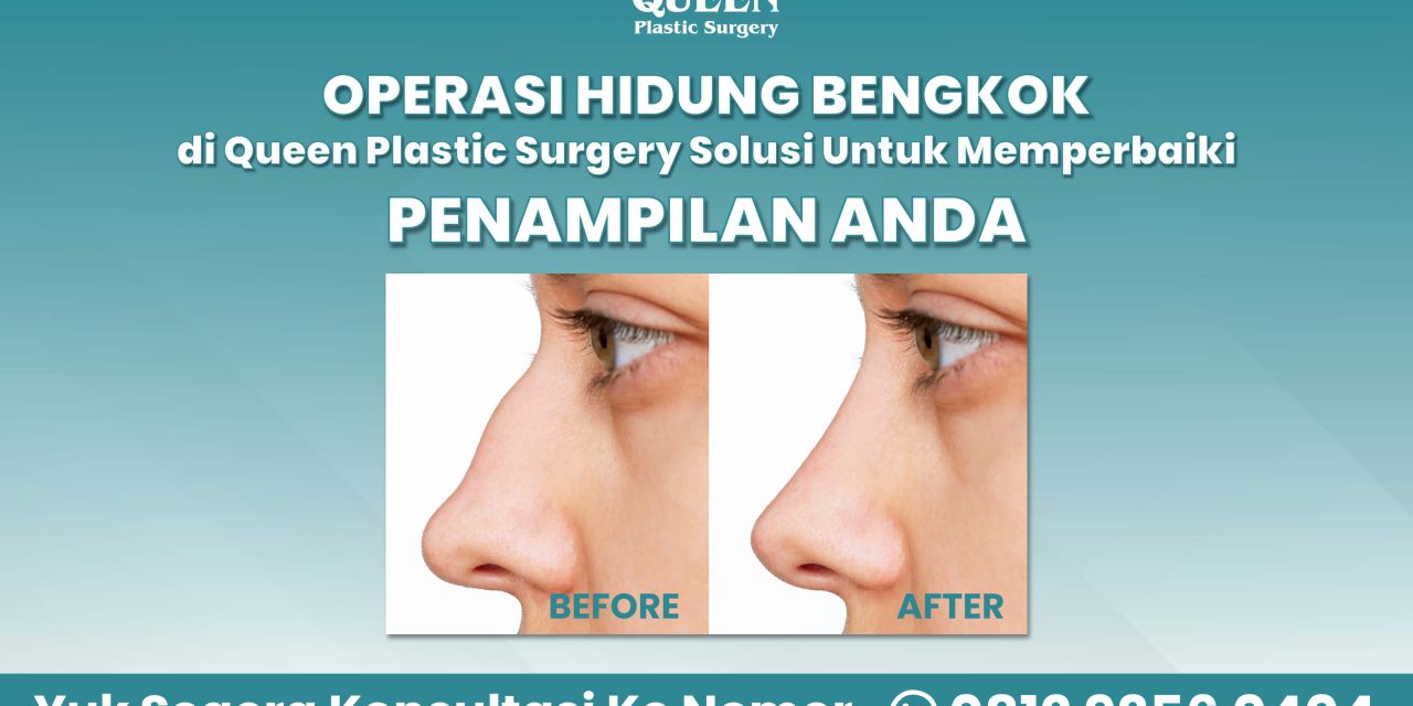 Operasi Hidung Bengkok di Queen Plastic Surgery
