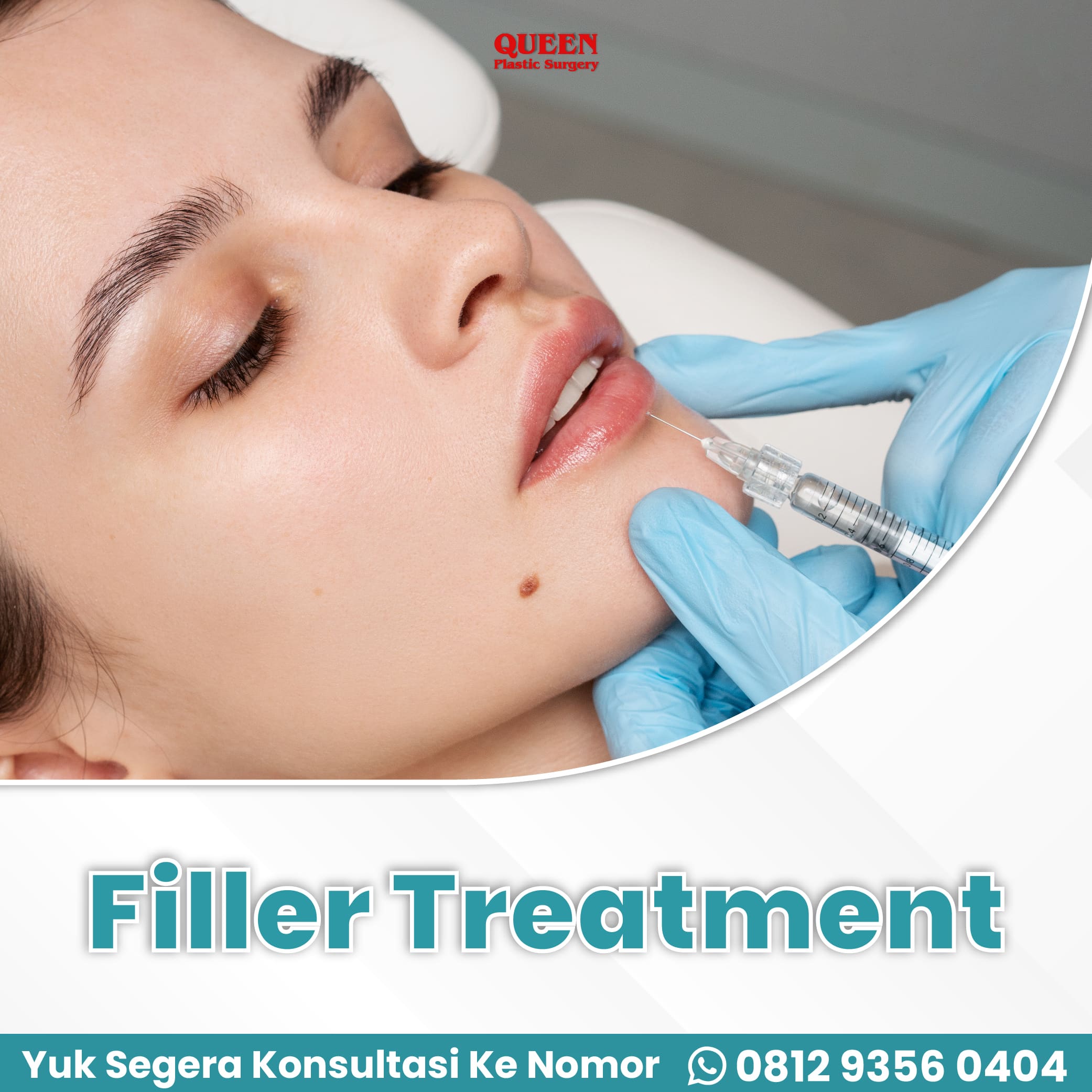 WEB FILLER TREATMENT (1) https://queenplasticsurgery.id/wp-content/uploads/2024/02/WEB-FILLER-TREATMENT-1.jpg
