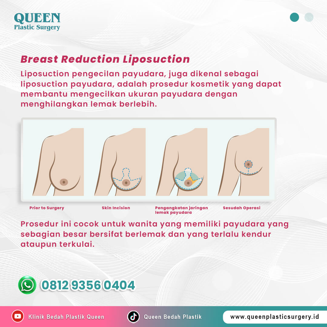 Artikel-Liposuction-Payudara