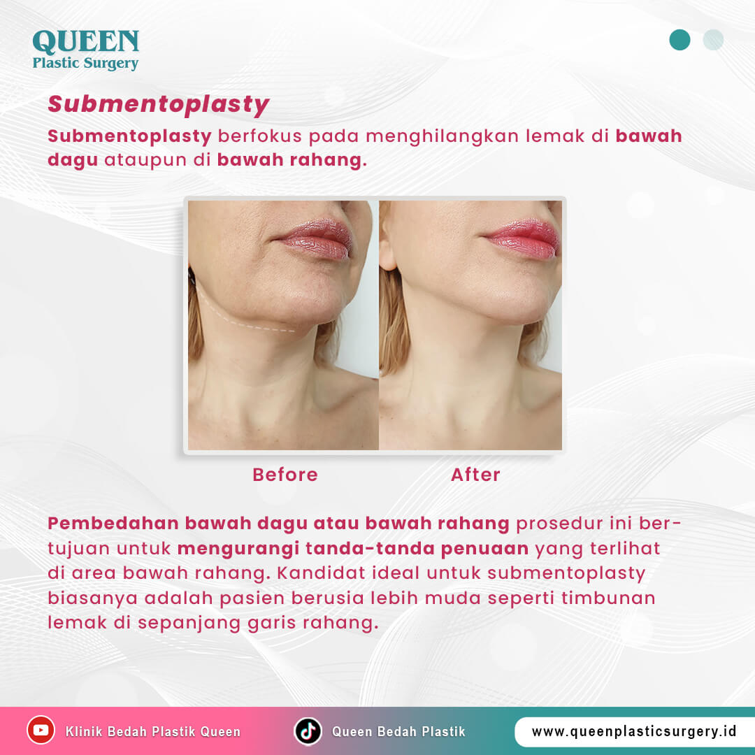Artikel-Submentoplasty-slide1 (1)
