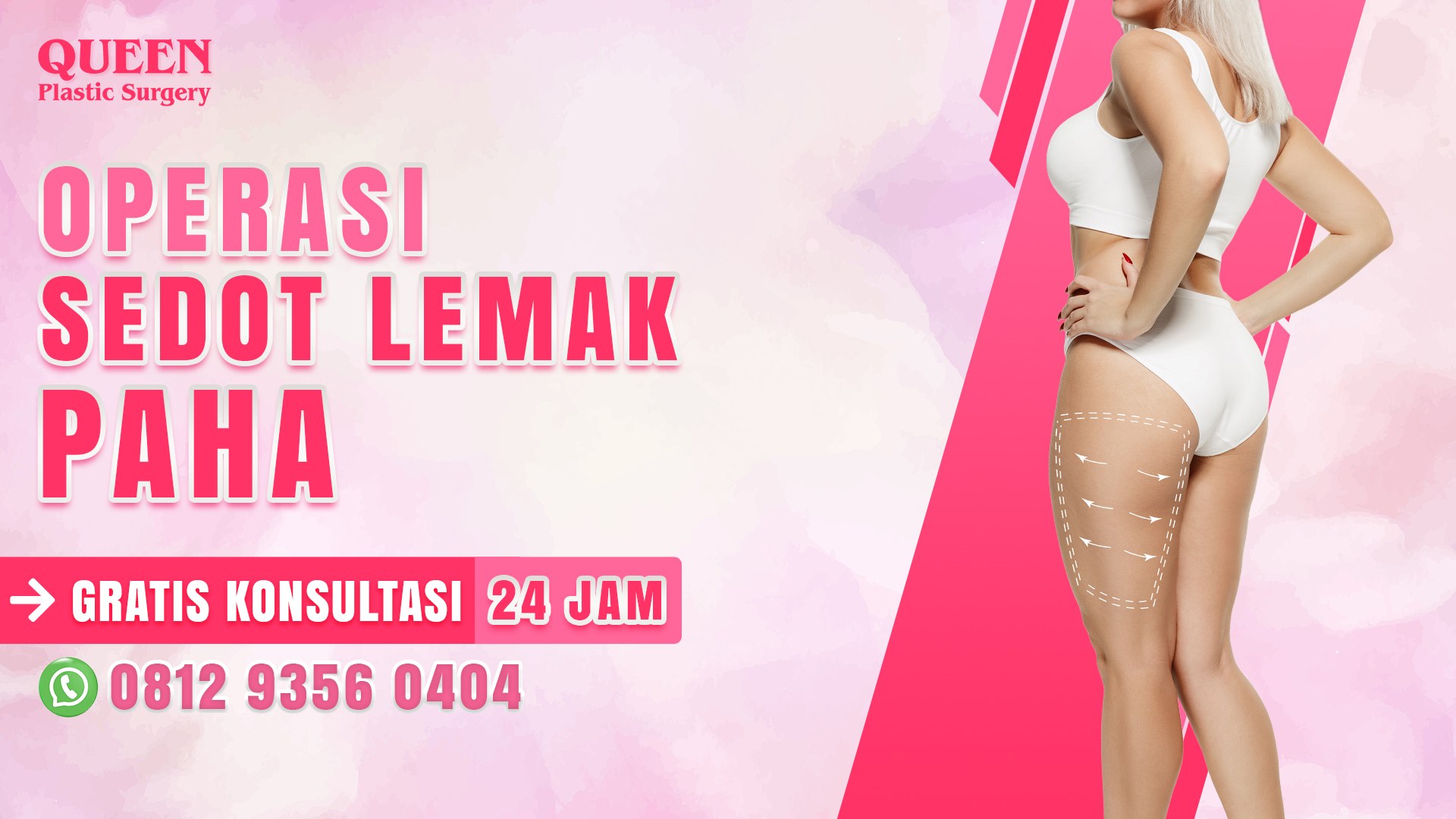 https://queenplasticsurgery.id/wp-content/uploads/2024/04/Website-Categories-Operasi-Sedot-Lemak-Paha-1.jpg