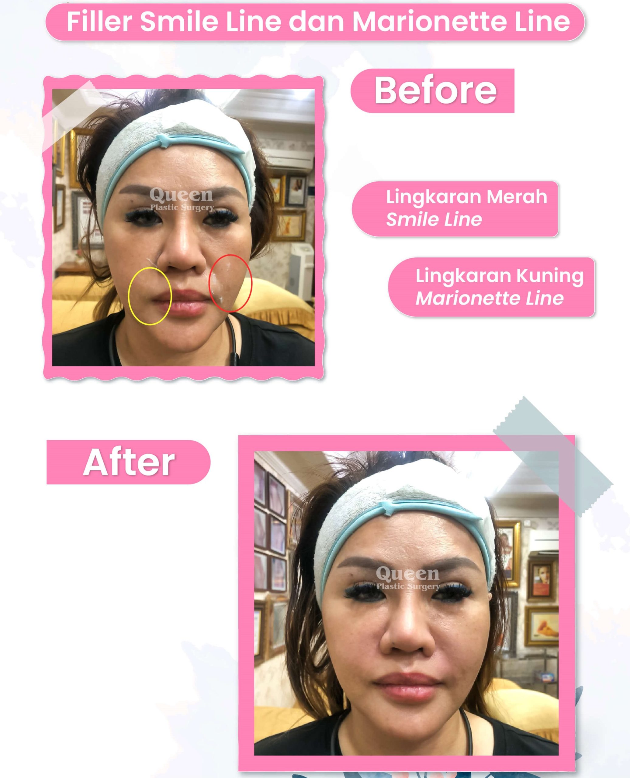 Filler Smile Line dan Marionette IGS TESTI TREATMENT (1) (1)
