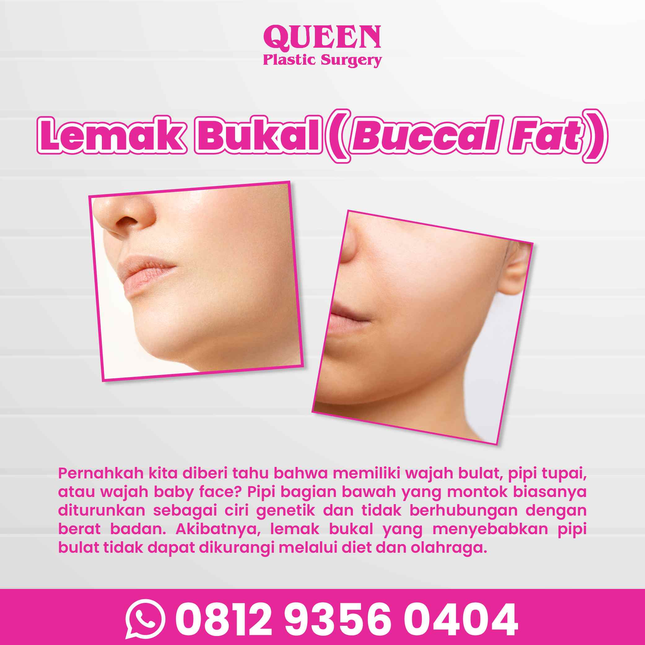BISAKAH LEMAK BUKAL DAPAT DIHILANGKAN DENGAN FACELIFT?