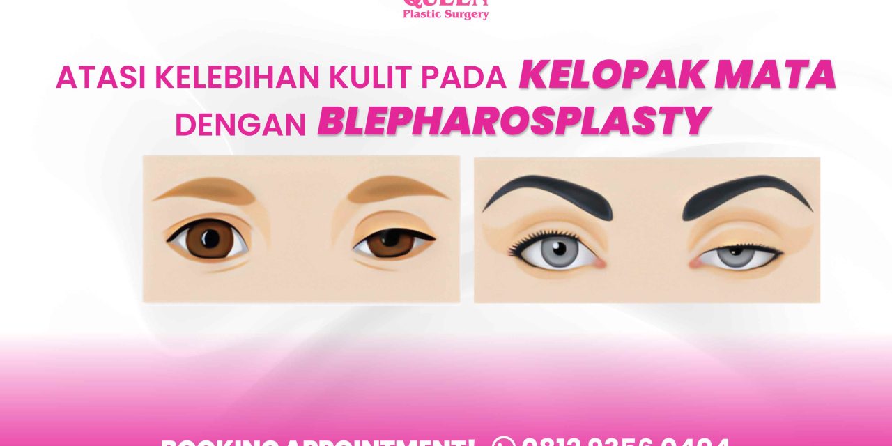 BLEPHAROPTOSIS MENGATASI KELOPAK MATA