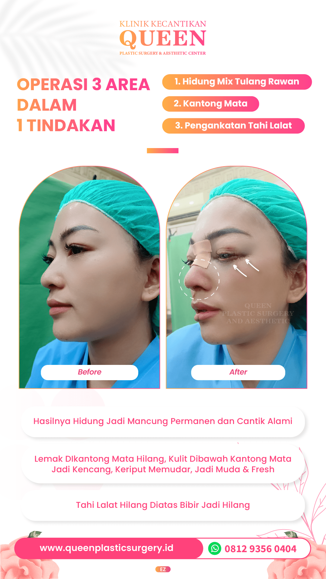 Hasil Rhinoplasty Queen Plastic Surgery, foto 17