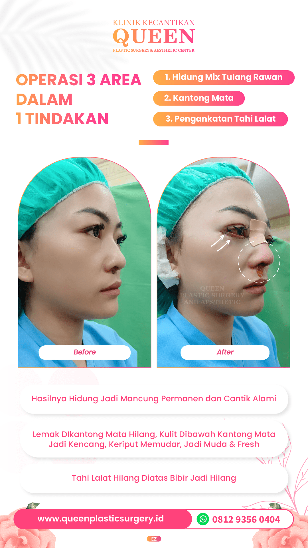 Hasil Rhinoplasty Queen Plastic Surgery, foto 18