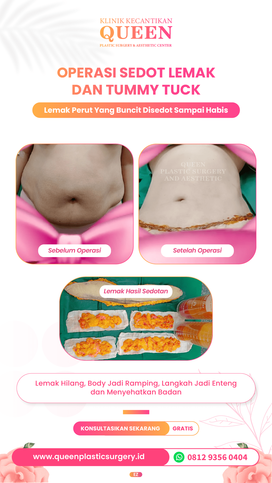 "Tummy Tuck (Abdominoplasty): Memilih Antara Drain atau Tanpa Drain, Mana yang Terbaik untuk Anda?" "Perbandingan Tummy Tuck: Drain vs Tanpa Drain, Pilihan yang Tepat untuk Hasil Optimal" "Tummy Tuck Tanpa Drain: Keuntungan dan Kerugian Dibandingkan dengan Metode Ber-Drain" "Mengenal Tummy Tuck: Apa yang Perlu Anda Tahu tentang Drain dan Tanpa Drain?" "Tummy Tuck (Abdominoplasty) untuk Semua: Memahami Pilihan Drain vs Tanpa Drain"
