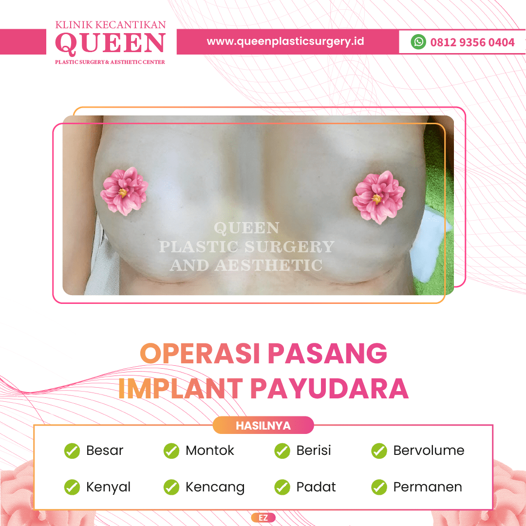 Hasil Breast Implant Queen Plastic Surgery, foto 13