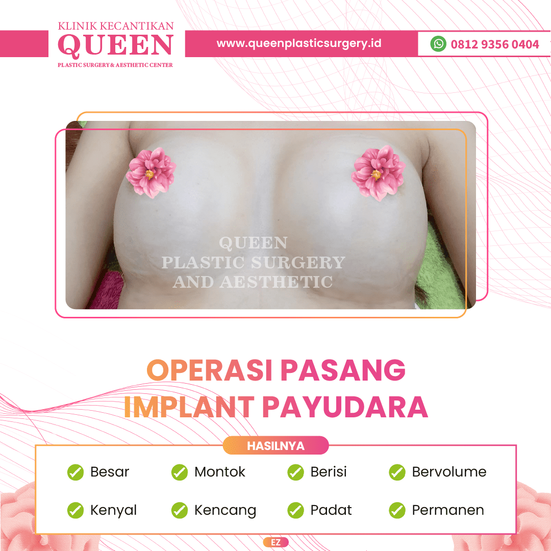 Hasil Breast Implant Queen Plastic Surgery, foto 5