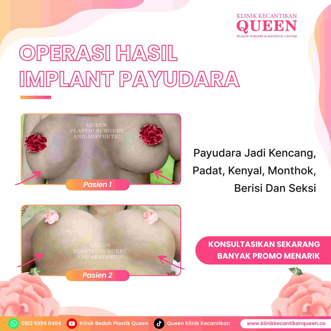 Hasil Breast Implant Queen Plastic Surgery, foto 77