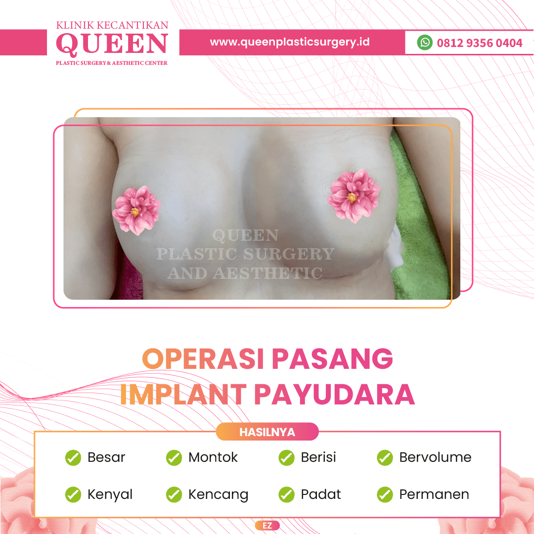 Hasil Breast Implant Queen Plastic Surgery, foto 6
