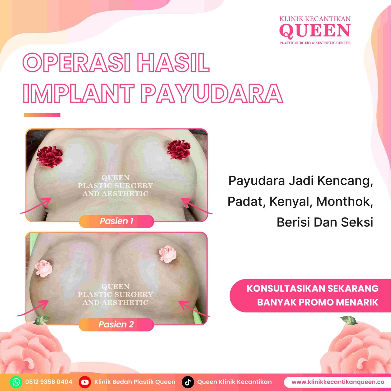Hasil Breast Implant Queen Plastic Surgery, foto 78