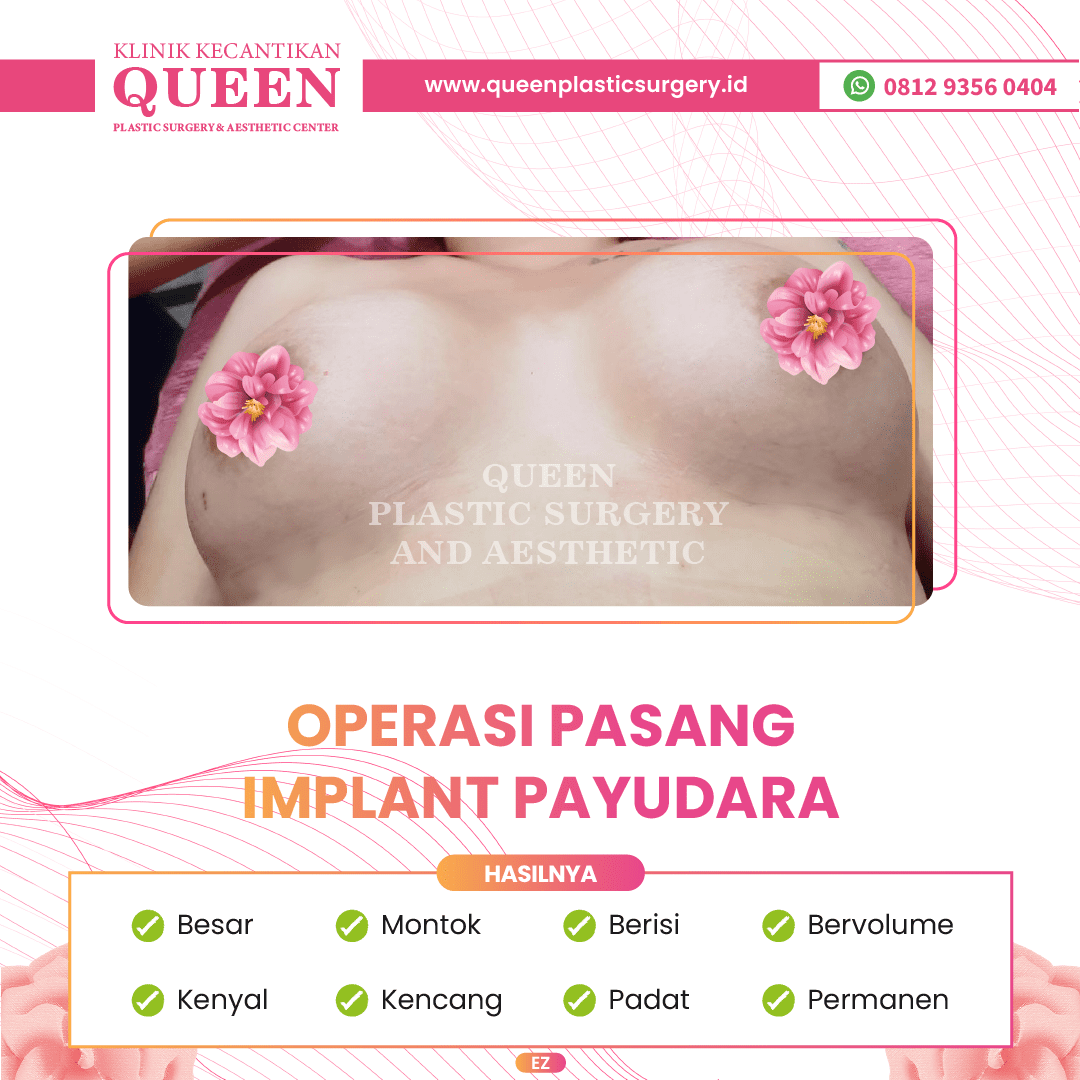 Hasil Breast Implant Queen Plastic Surgery, foto 7