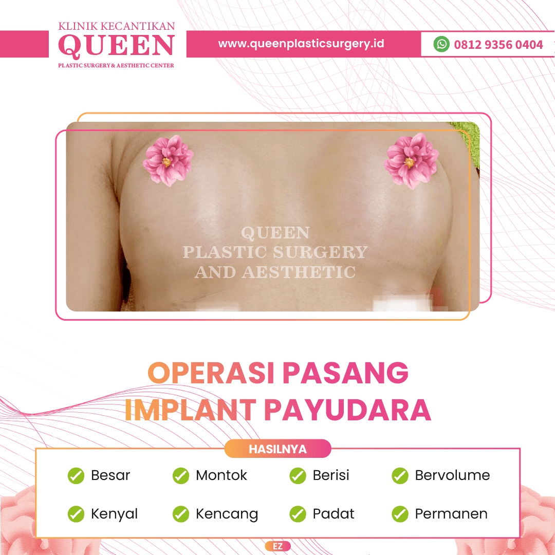 Hasil Breast Implant Queen Plastic Surgery, foto 8