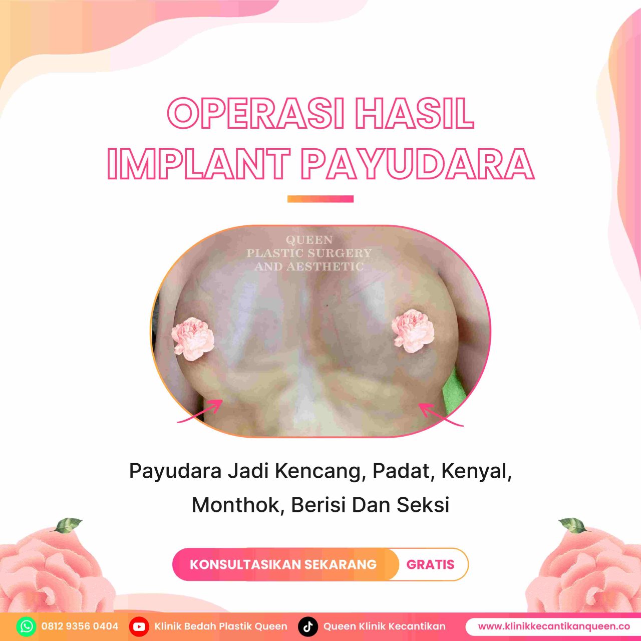 Hasil Breast Implant Queen Plastic Surgery, foto 79